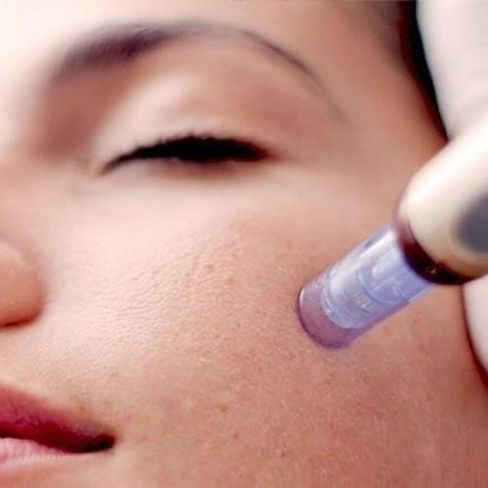 Everything You Need to Know About Microneedling and Aquagold Fine Touch Treatment